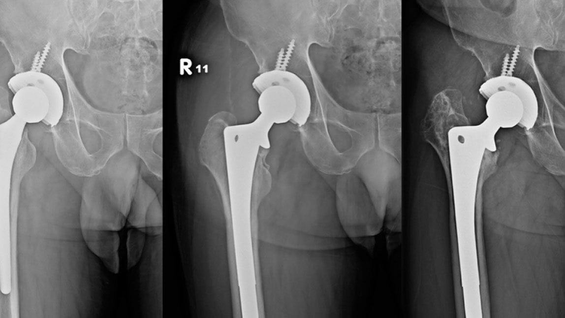 Cover Image for Bone Quality and Orthopaedic Surgery